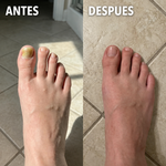 Dentone® - Sérum Antihongos